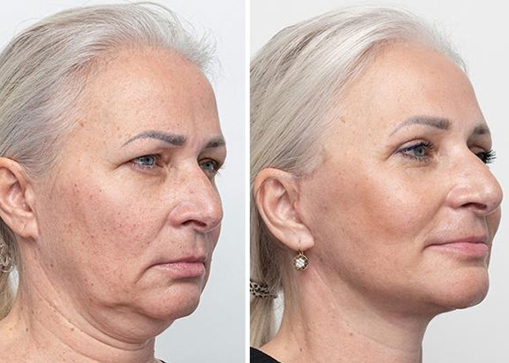 Derin Plan Yüz Germe (Deep Plane Facelift)