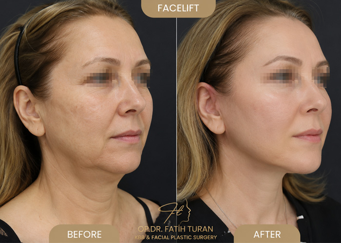 Yüz Germe (Face Lift)