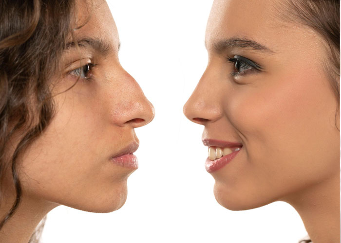 Female Rhinoplasty Trends and New Techniques